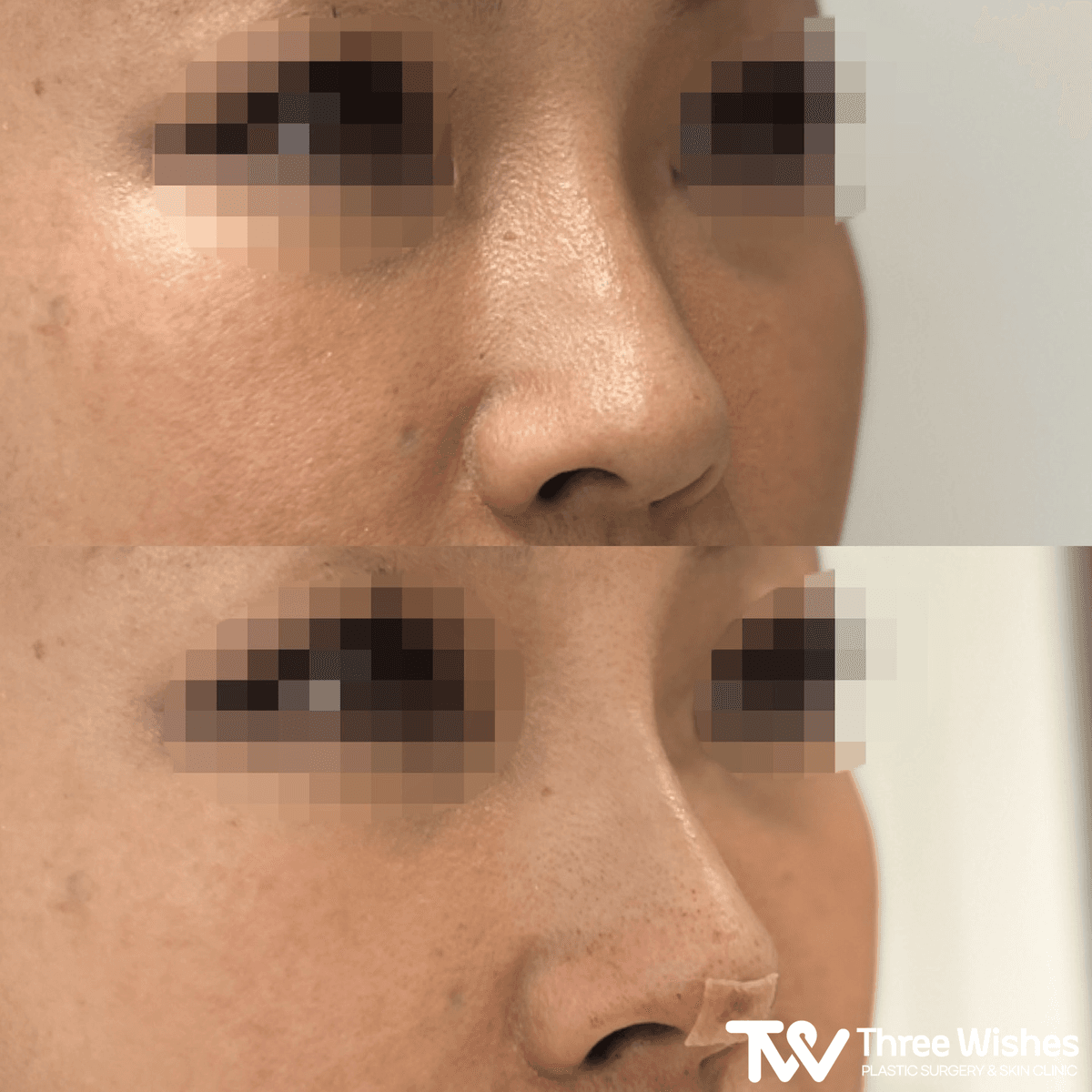 Before and After Nose Thread Lift
