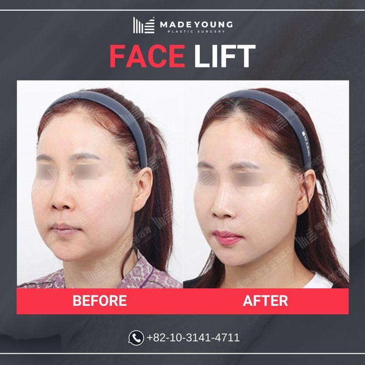 Before and After Face Lift