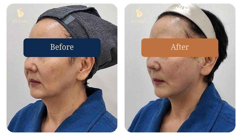 Before and After Thread Lift