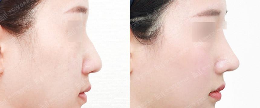 Before and After Rhinoplasty