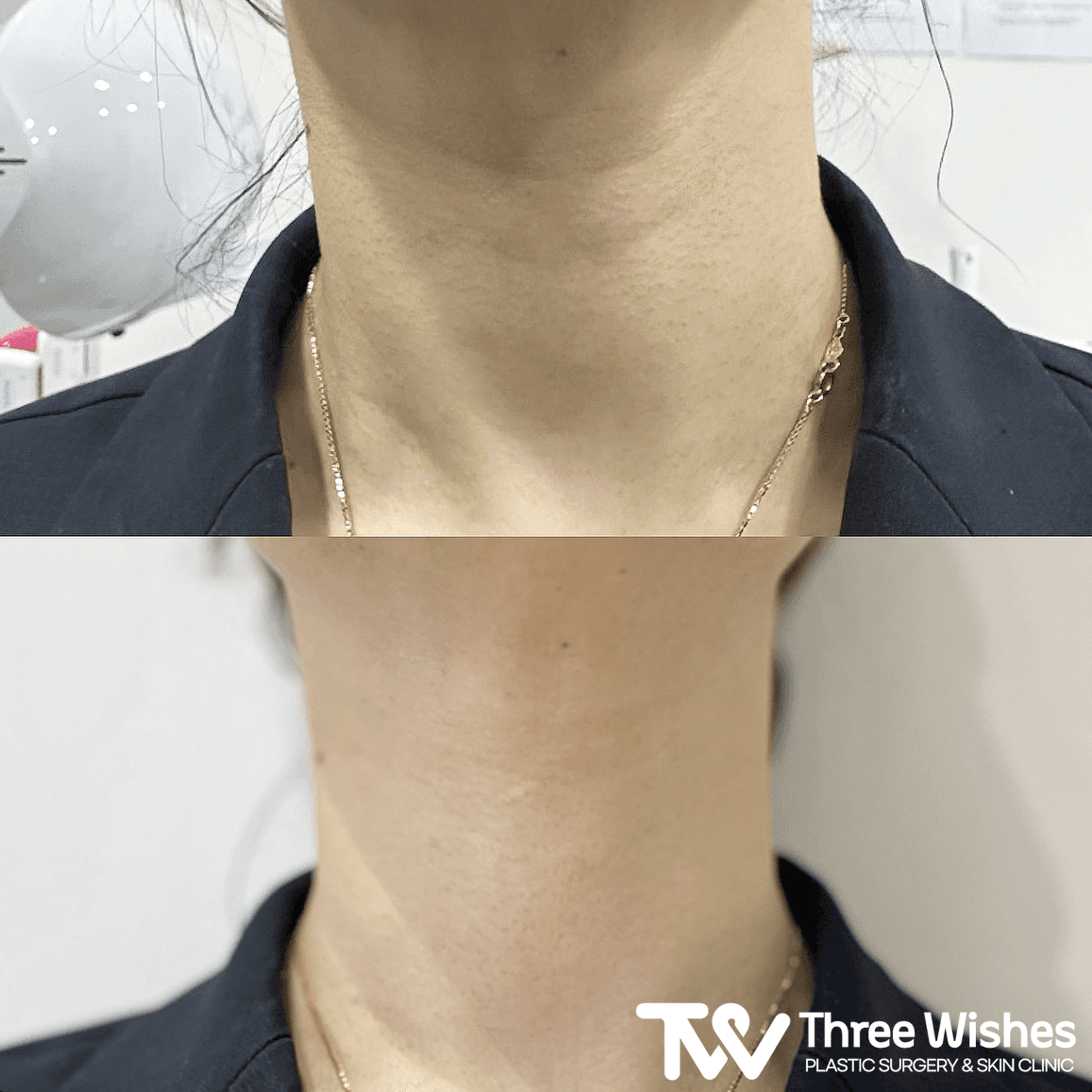 Before and After Neck Wrinkle Treatment