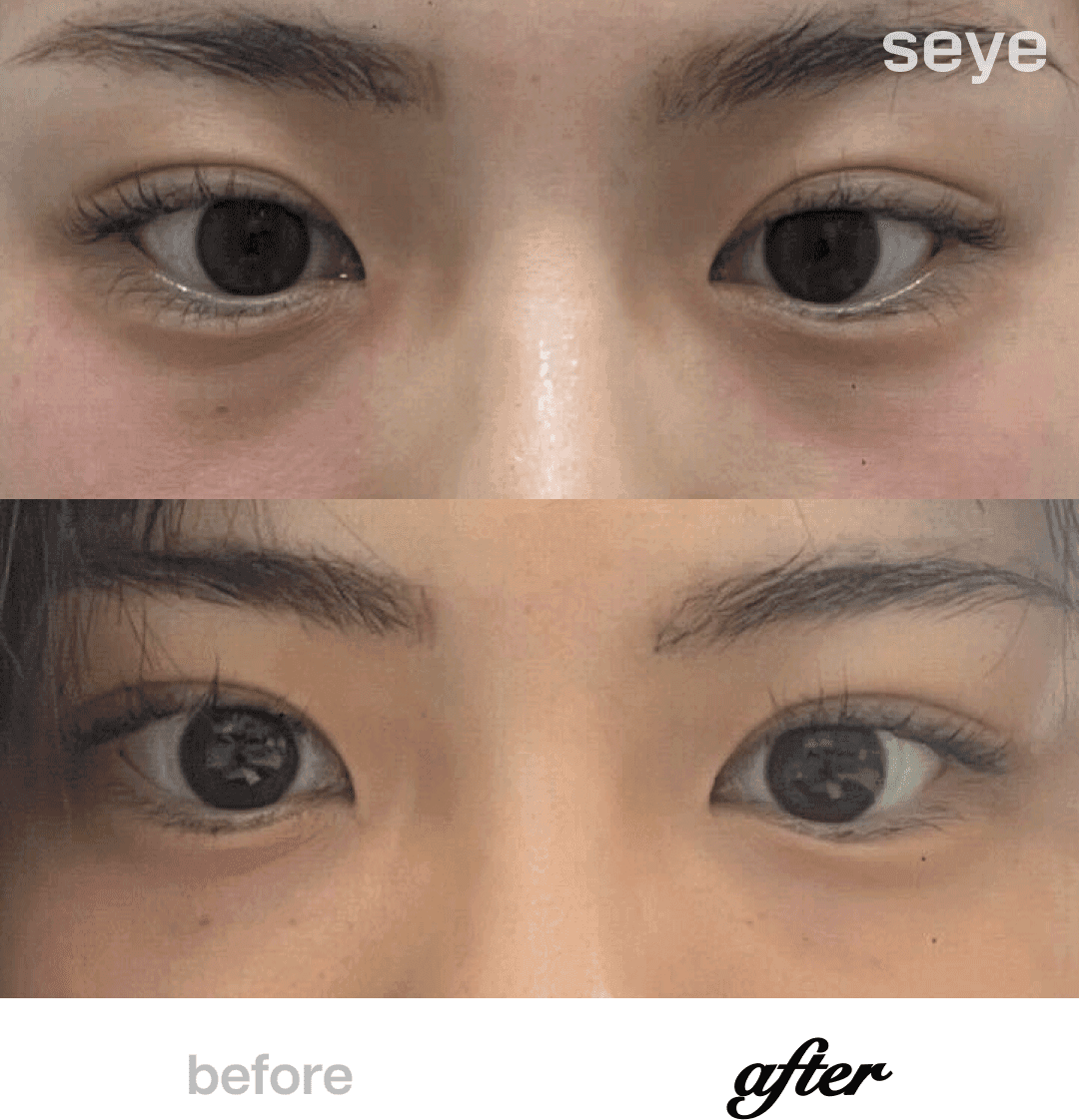 Before and After Skin Booster