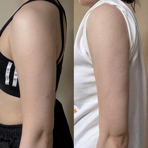 Before and After Fat Dissolving Injection