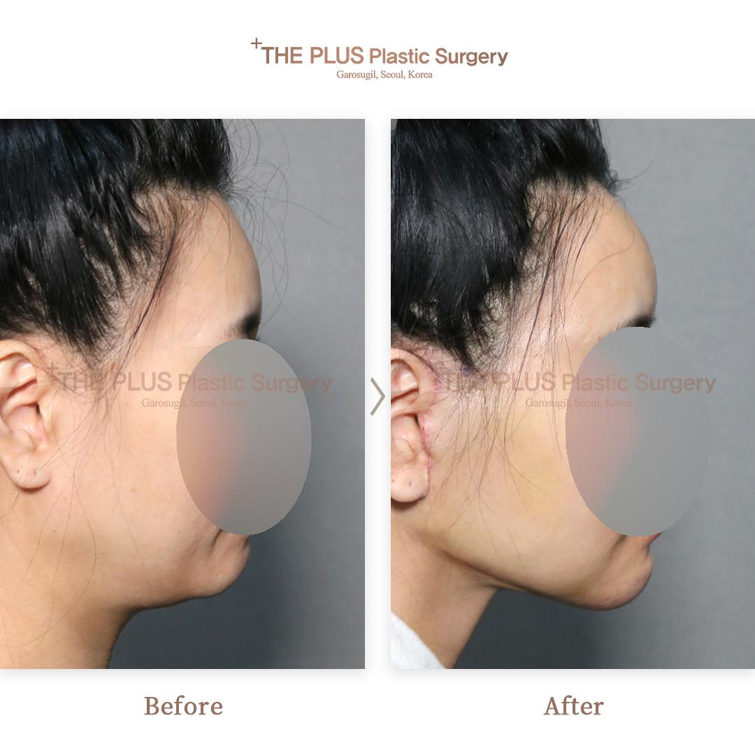 Before and After Double Chin Tightening