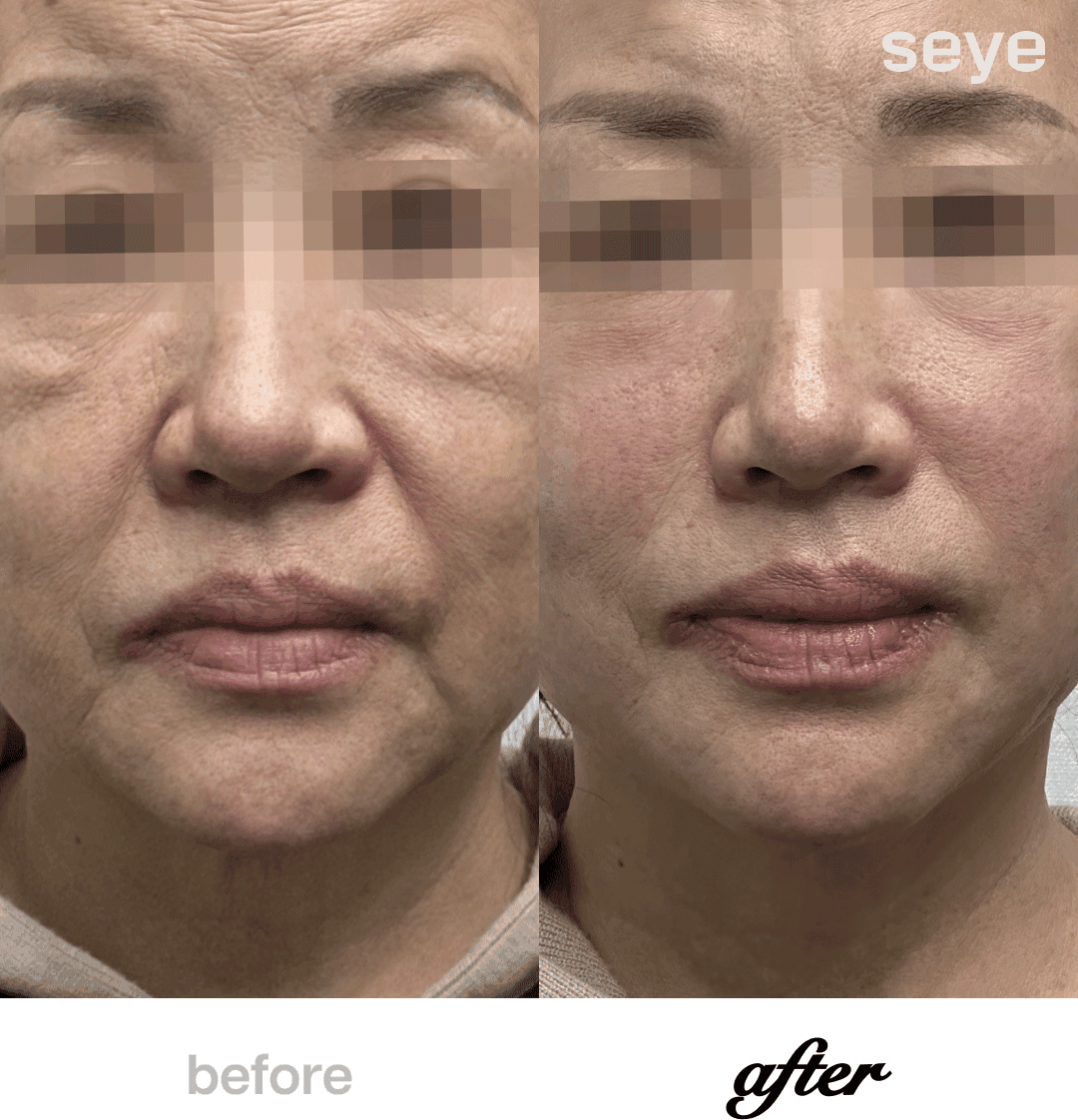 Before and After Thread Lift