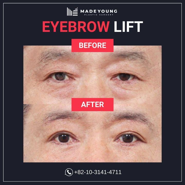 Before and After Eyebrow Lift