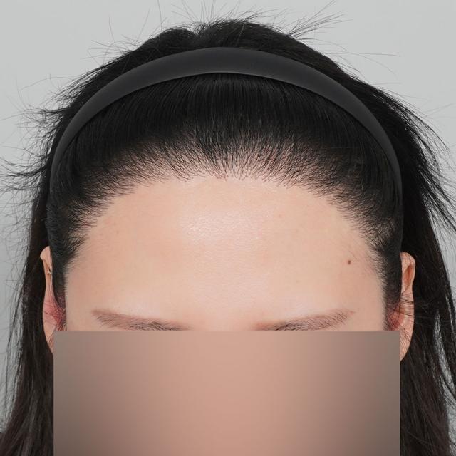 After Hair Transplant