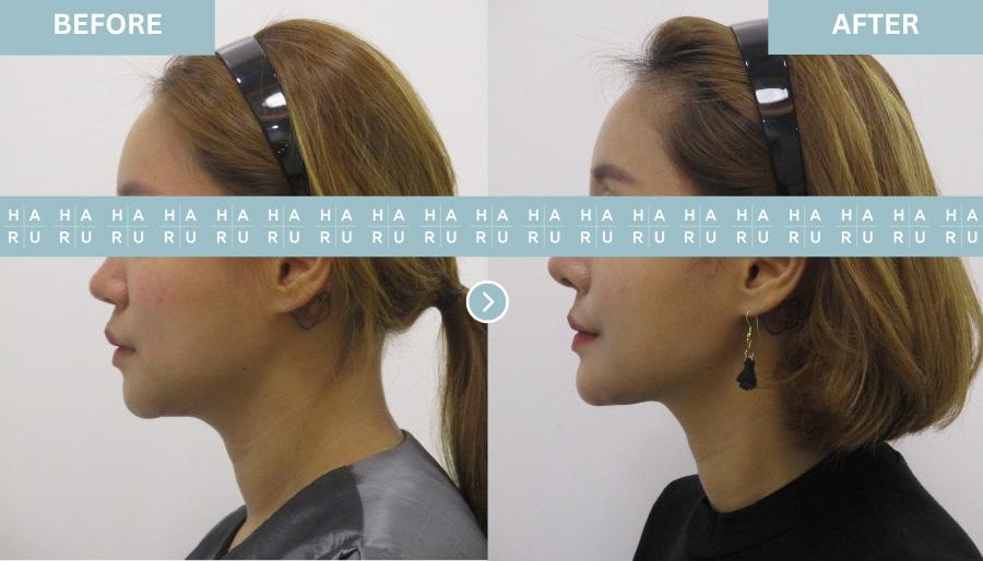 Before and After Chin Botox