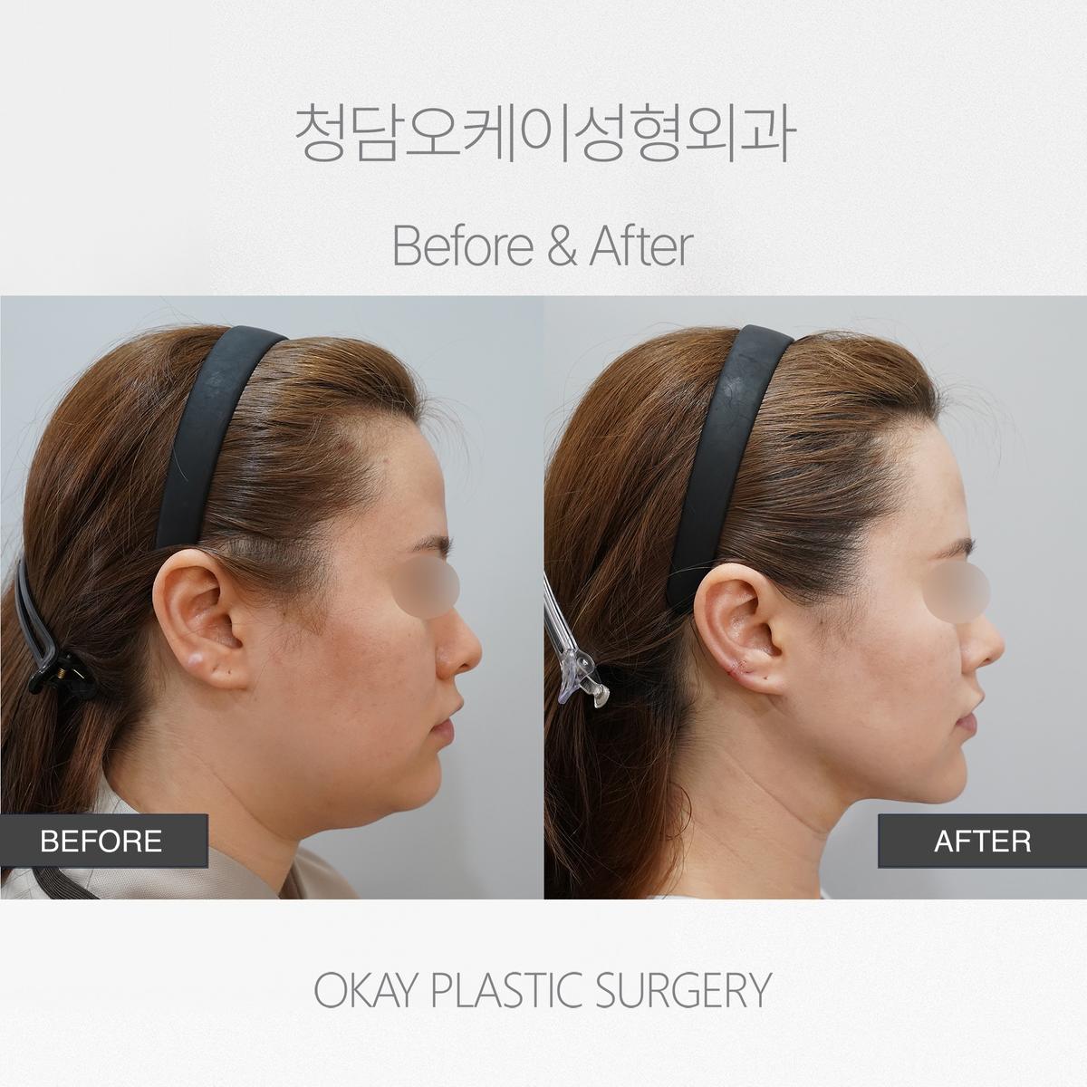 Before and After Double Chin Tightening