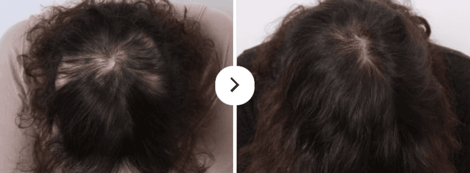 Before and After Hair Loss Treatment