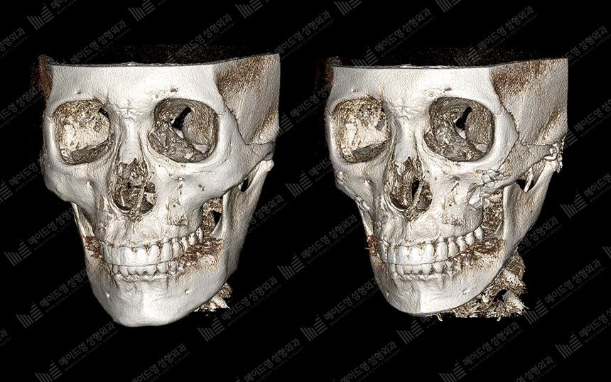 Before and After Face Contouring