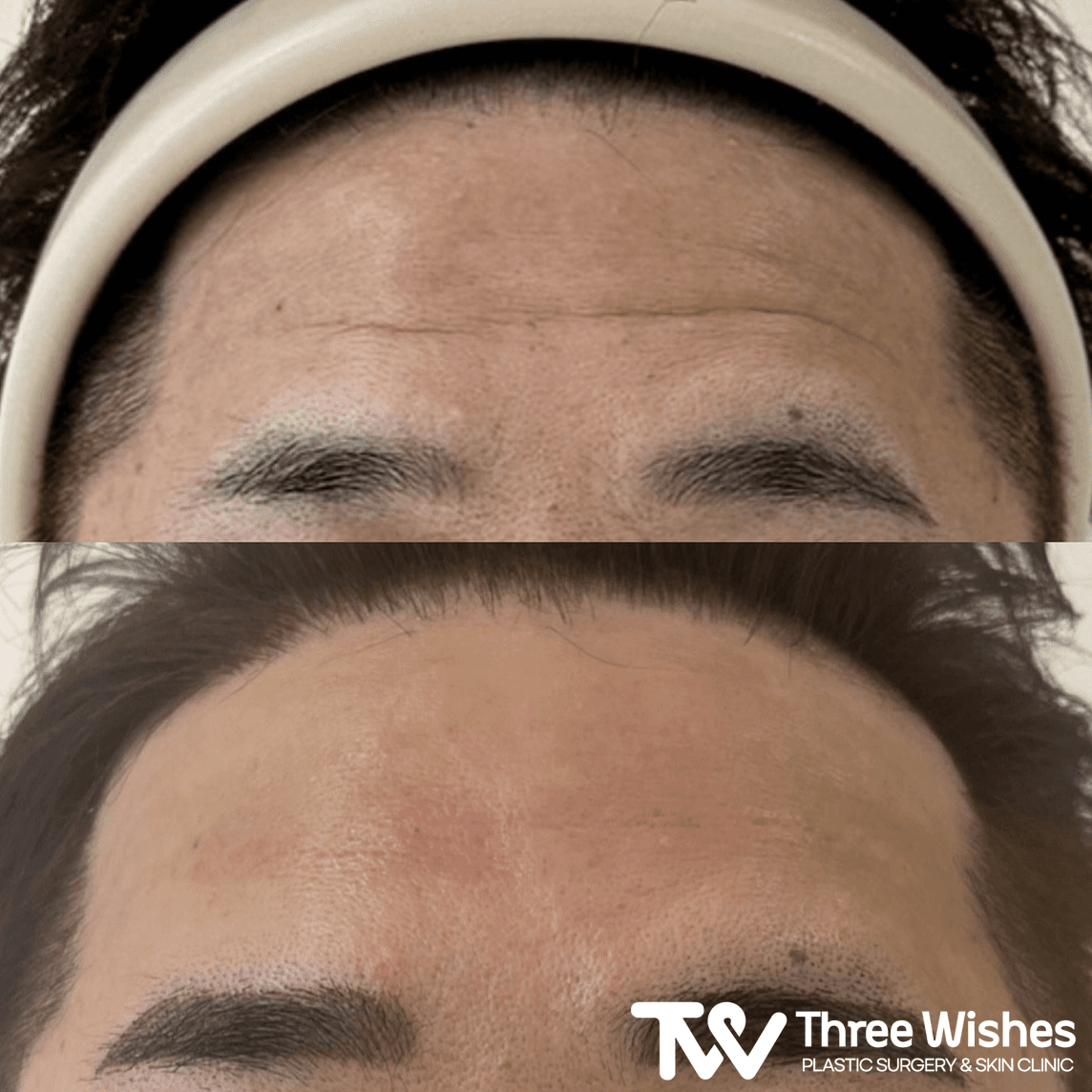 Before and After Forehead Filler