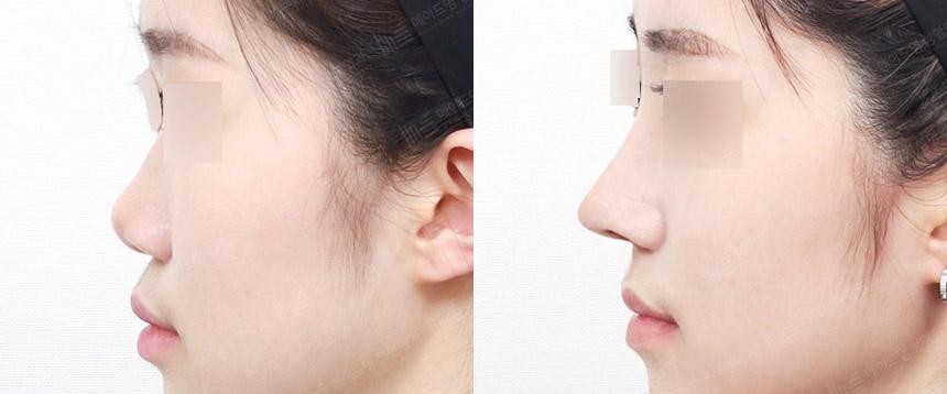 Before and After Rhinoplasty