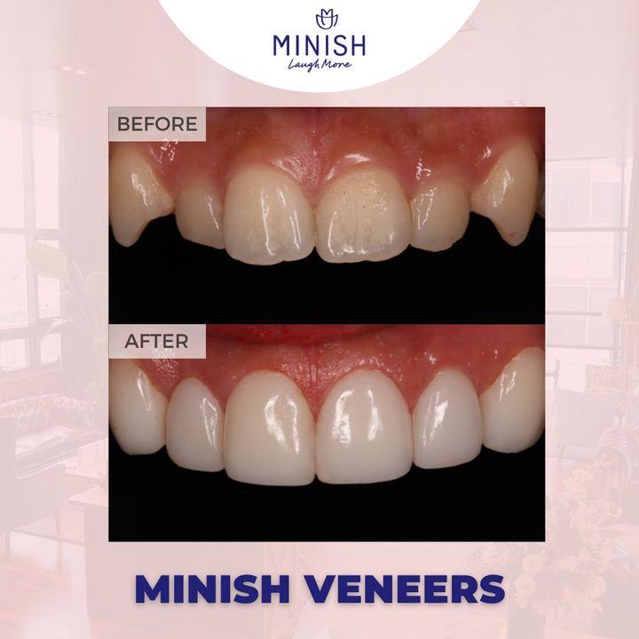Before and After Veneers