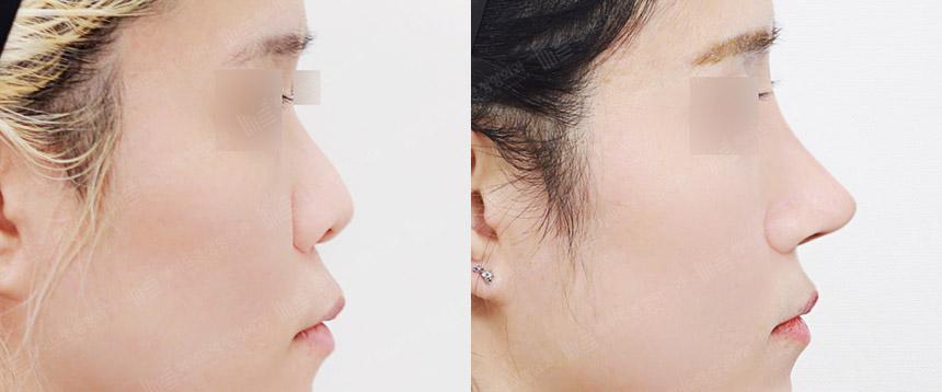 Before and After Rhinoplasty