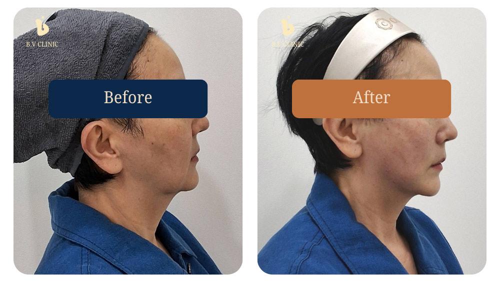 Before and After Thread Lift