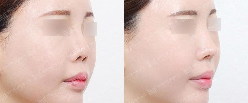 Before and After Rhinoplasty