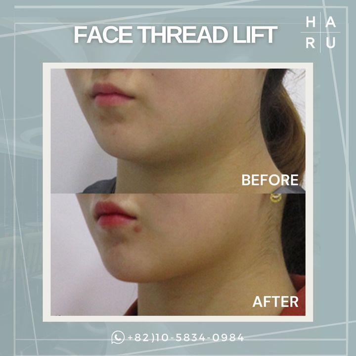 Before and After Thread Lift