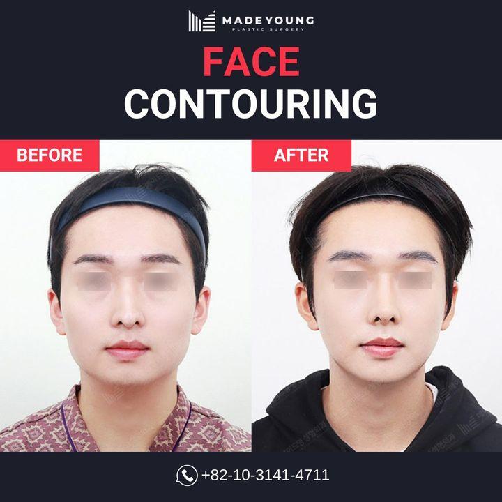 Before and After Face Contouring
