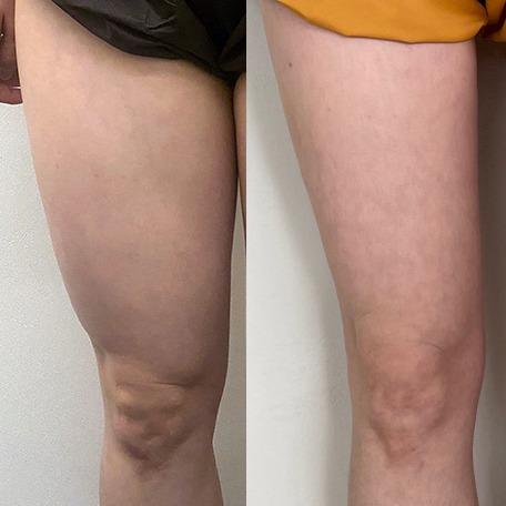 Before and After Fat Dissolving Injection