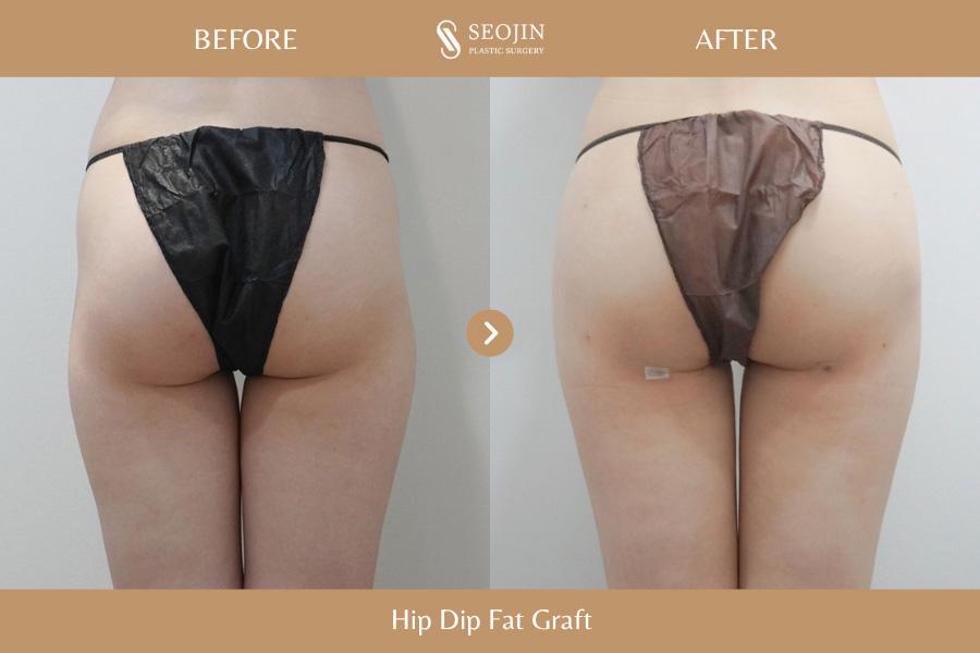 Before and After Hip Dip Fat Grafting
