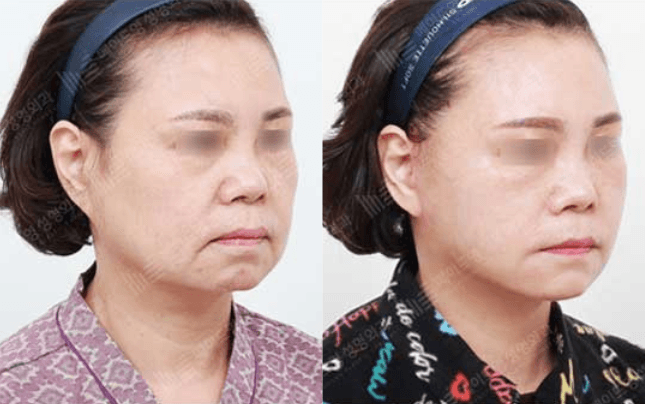 Before and After Face Lift