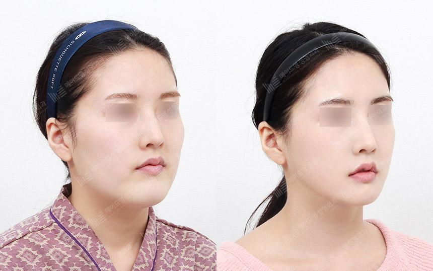 Before and After Face Contouring