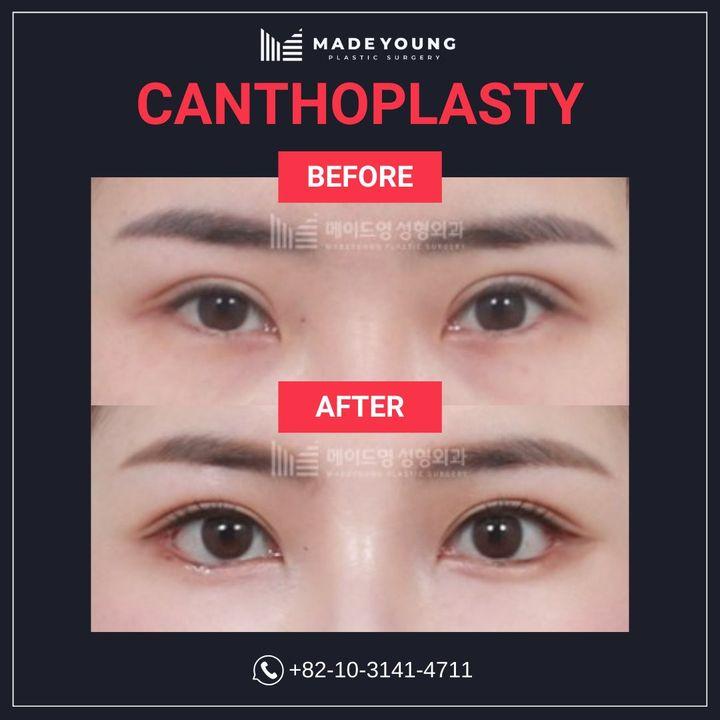 Before and After Canthoplasty