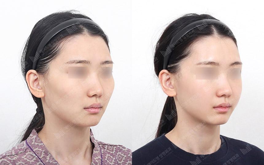 Before and After Face Contouring