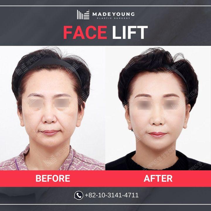 Before and After Face Lift