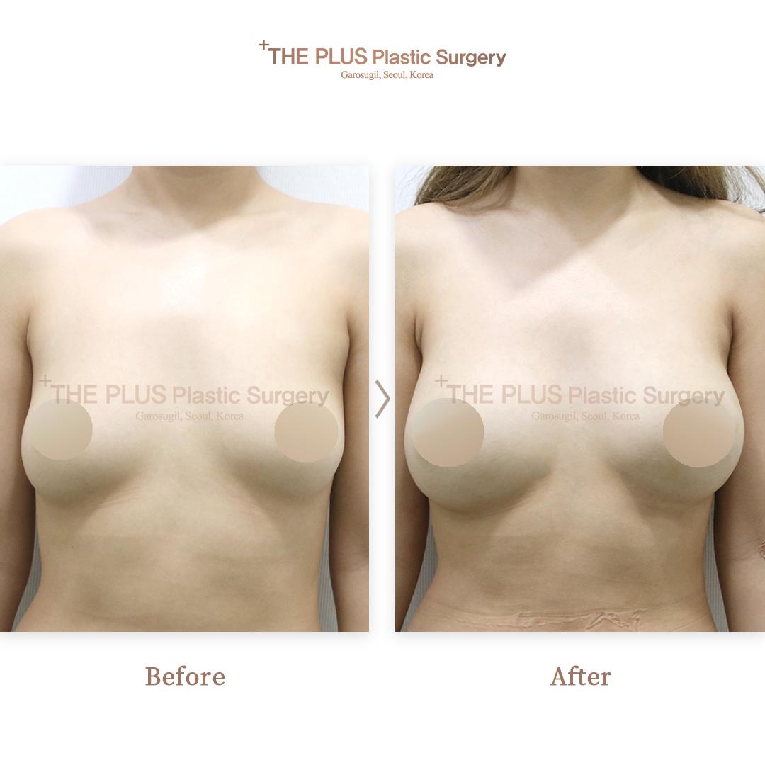 Before and After Breast Fat Grafting