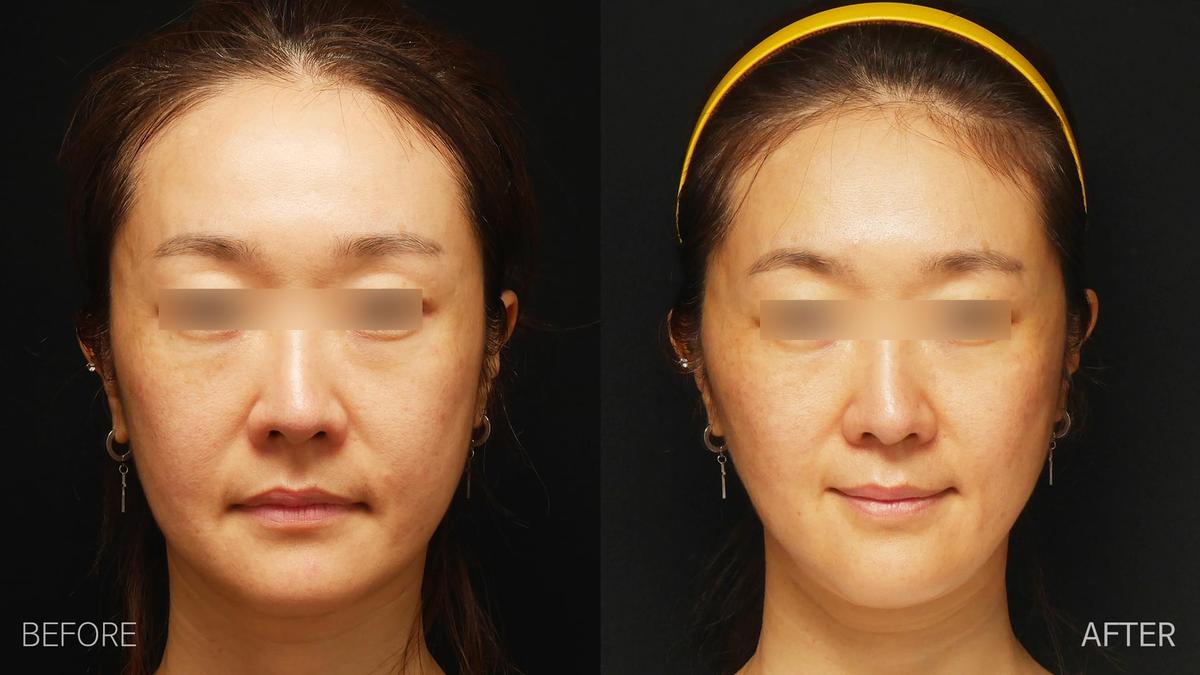 Before and After undefined