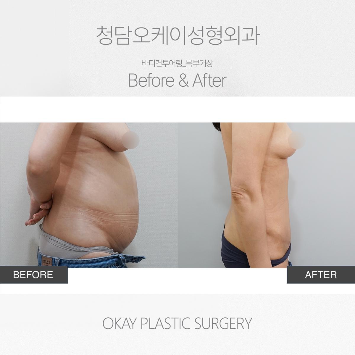 Before and After Tummy Tuck