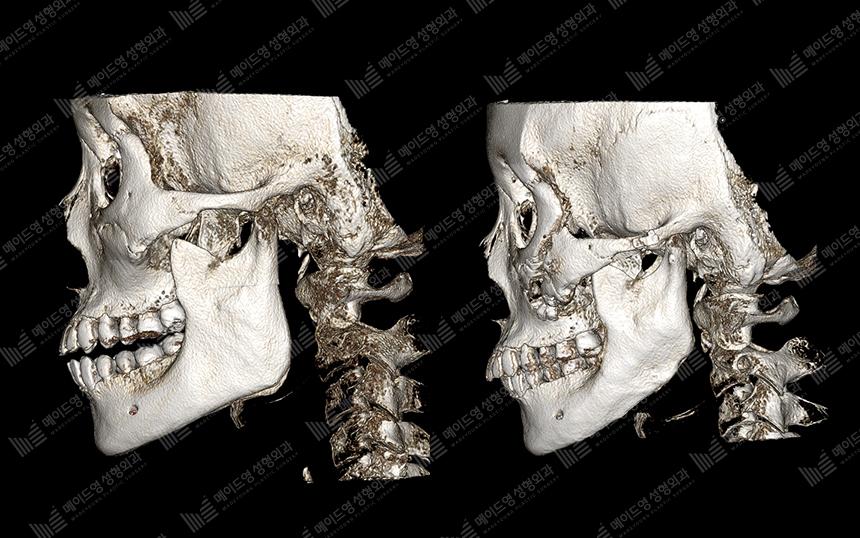 Before and After Face Contouring