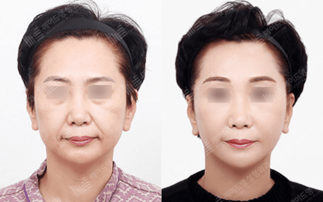 Before and After Face Lift