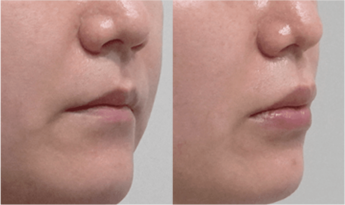 Before and After Face Fat Grafting