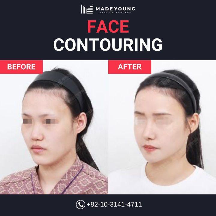 Before and After Face Contouring