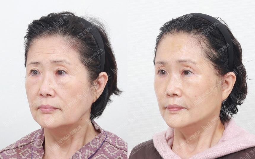 Before and After Face Lift