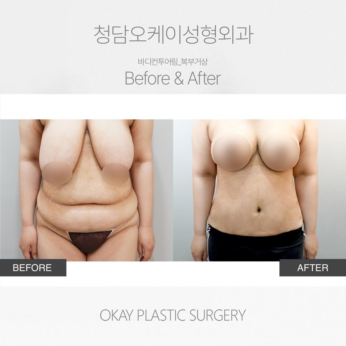 Before and After Tummy Tuck