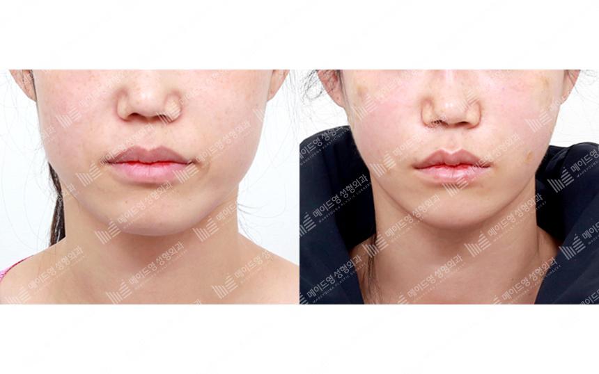 Before and After Face Lift