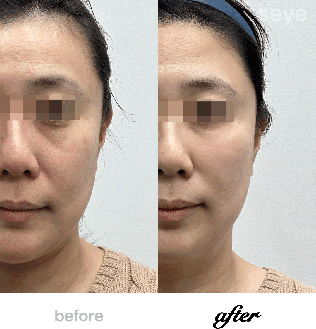 Before and After Skin Booster