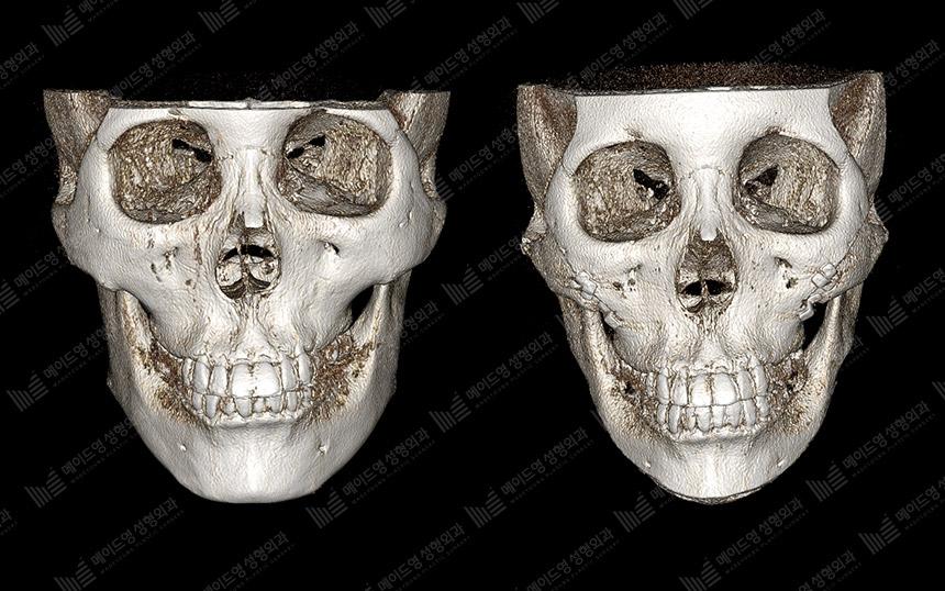 Before and After Face Contouring