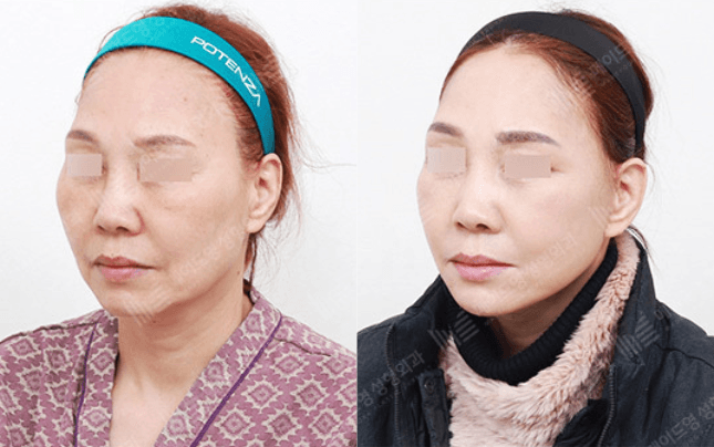 Before and After Face Lift