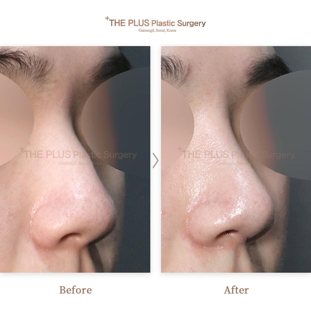 Before and After Septoplasty