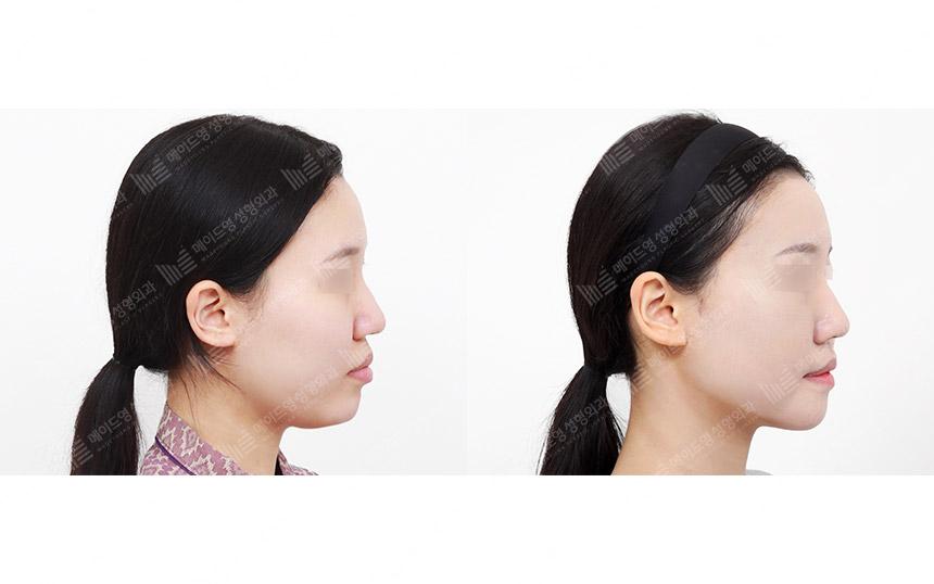 Before and After Face Lift