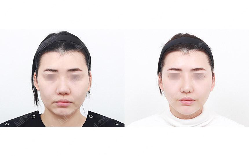 Before and After Face Lift