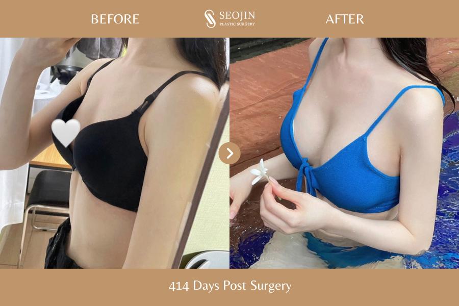 Before and After Breast Augmentation