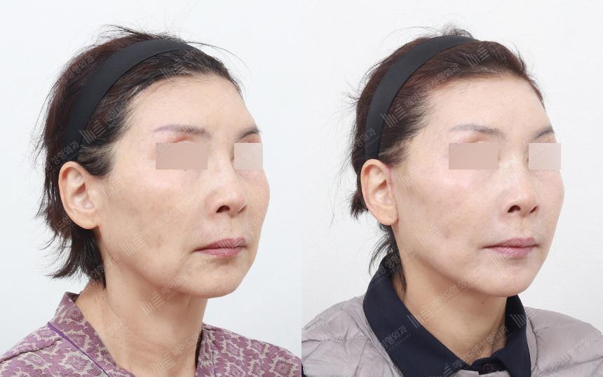 Before and After Face Lift