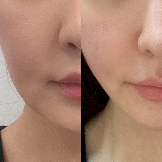 Before and After Face Contouring Injection