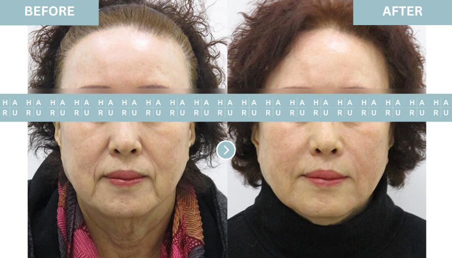 Before and After Collagen Filler